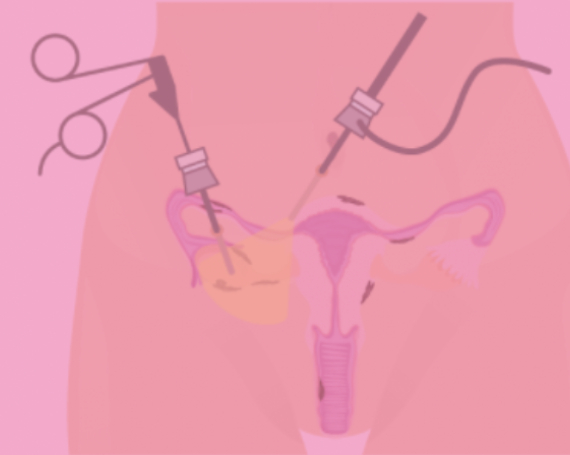 Cirugía ginecológica de mínima invasión