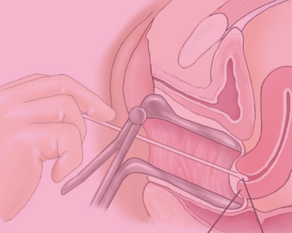 Papanicolaou y Colposcopia