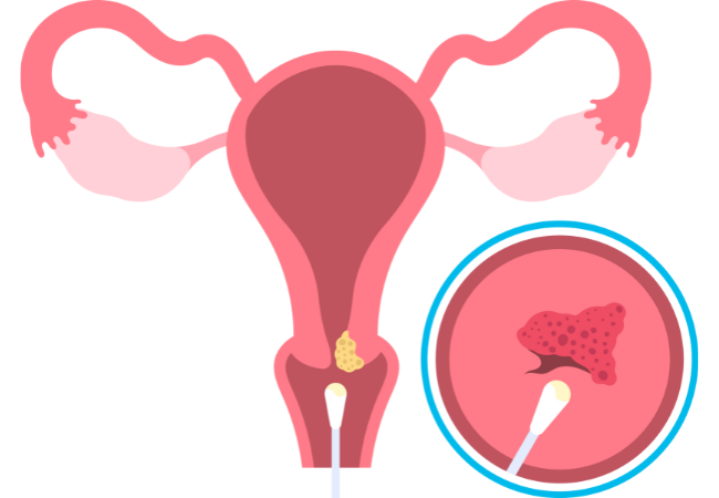 Papanicolaou y Colposcopia
